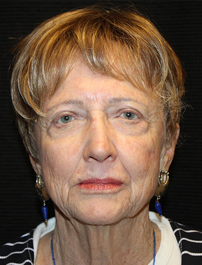 Patient #92784: FaceTite Before Image