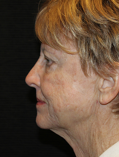 Patient #92784: FaceTite After Image