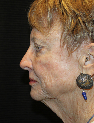 Patient #92784: FaceTite Before Image