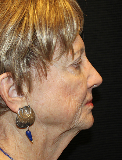 Patient #92784: FaceTite Before Image