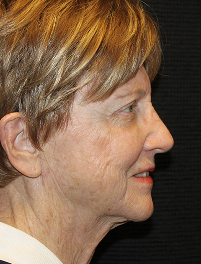 Patient #92784: FaceTite After Image