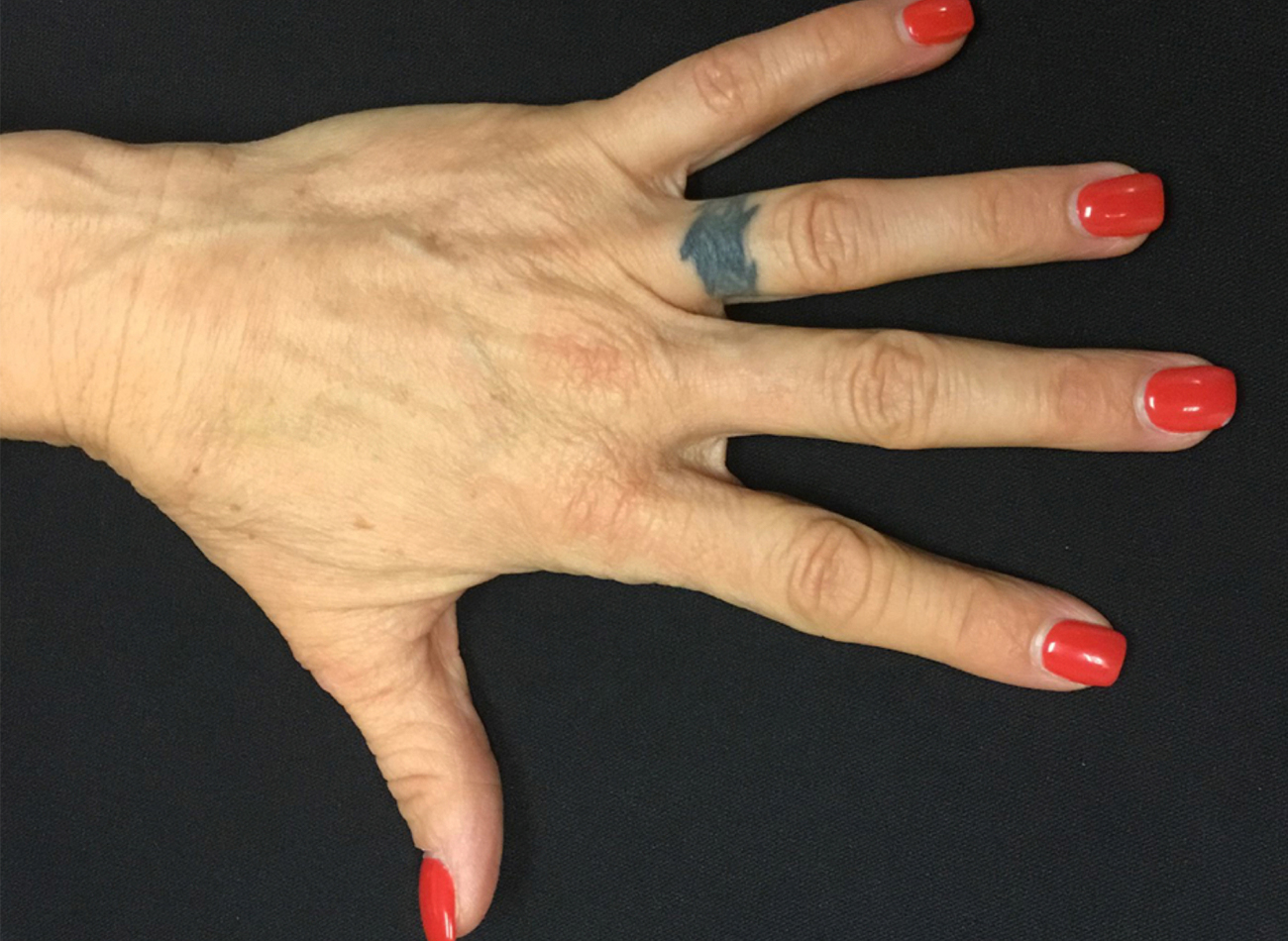 Patient #13241: Hand Rejuvenation After Image