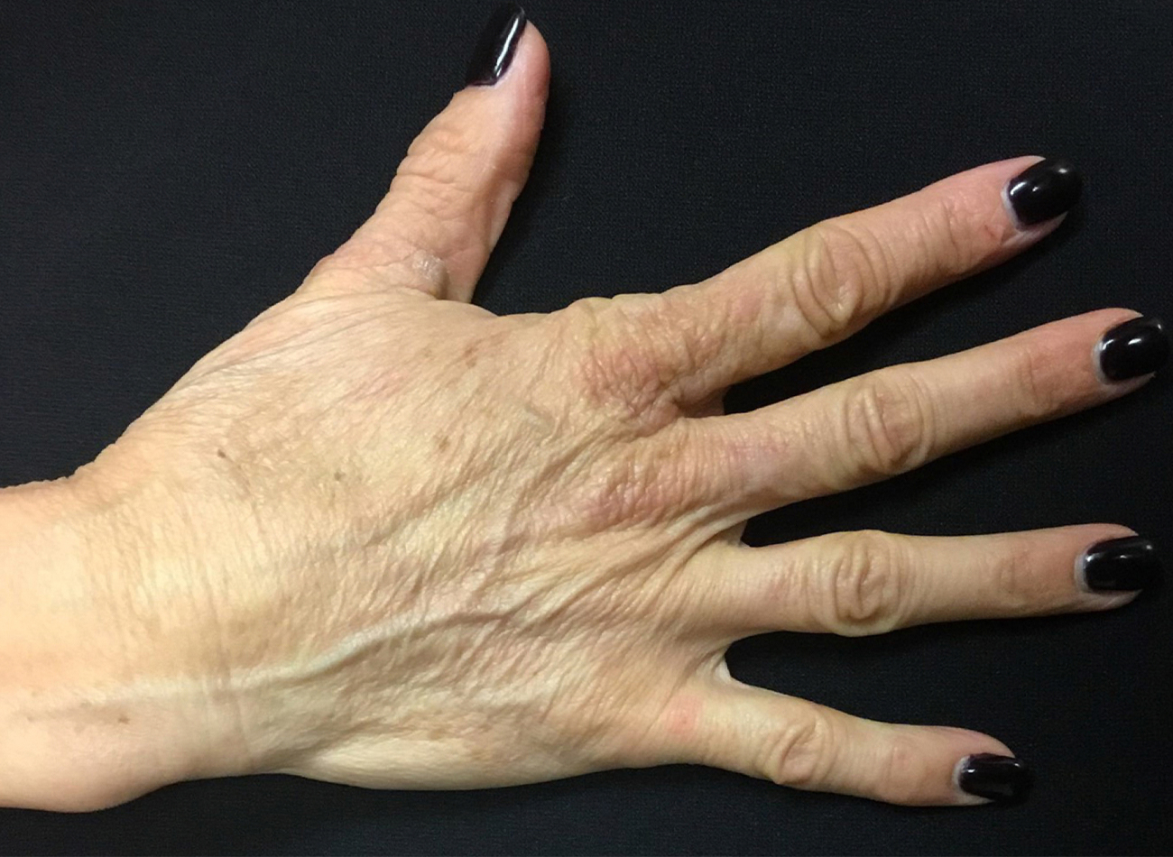 Patient #13241: Hand Rejuvenation Before Image