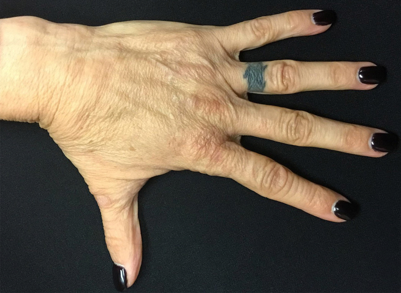 Patient #13241: Hand Rejuvenation Before Image