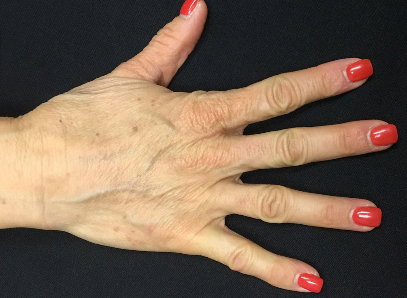 Patient #13241: Hand Rejuvenation After Image