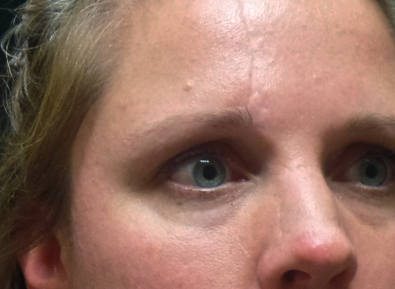 Patient #25798: IPL for Scarring After Image