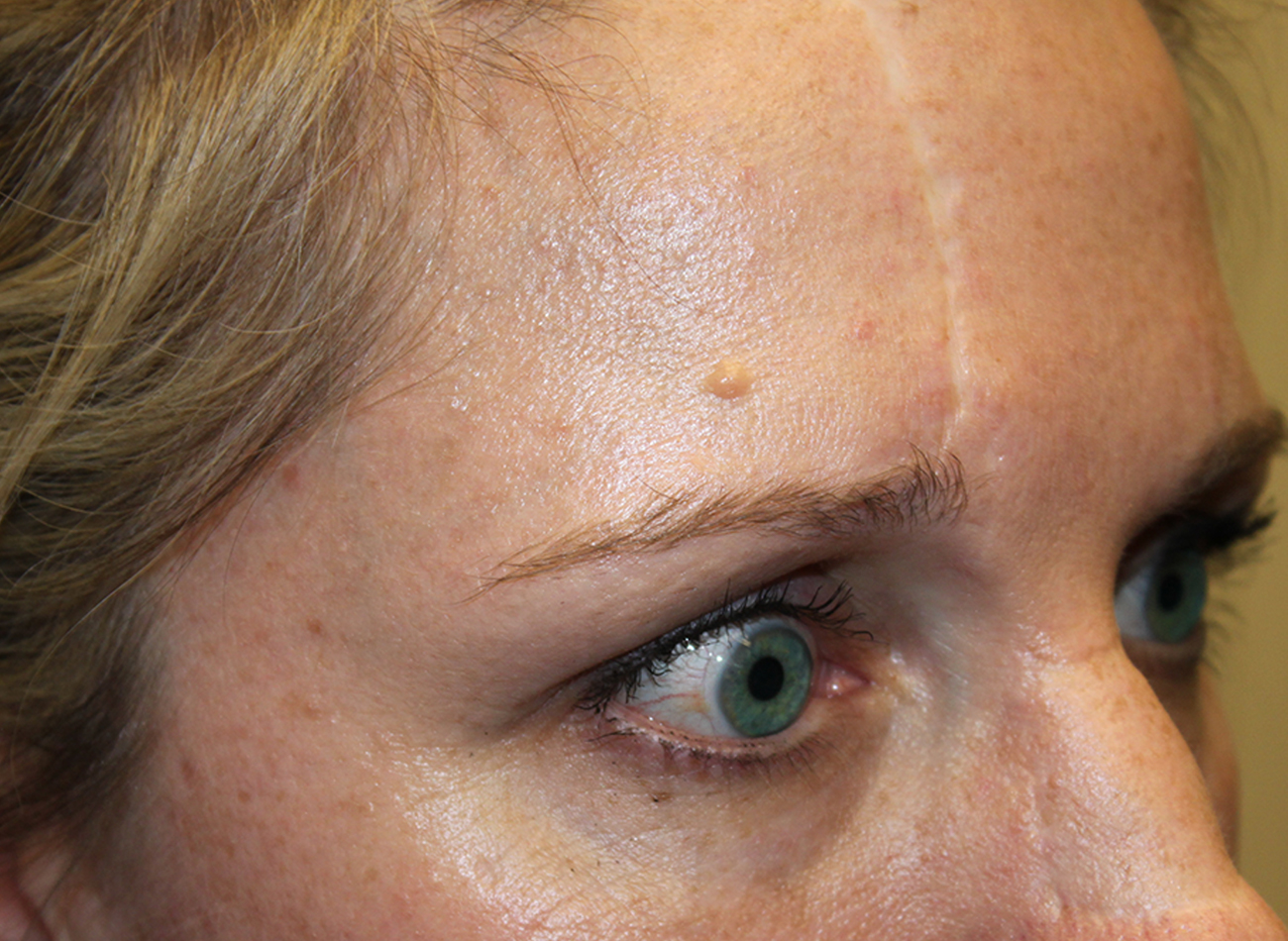 Patient #25798: IPL for Scarring Before Image