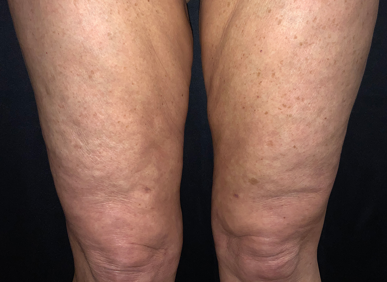 Patient #44674-2: Skin Tightening with Radiofrequency After Image