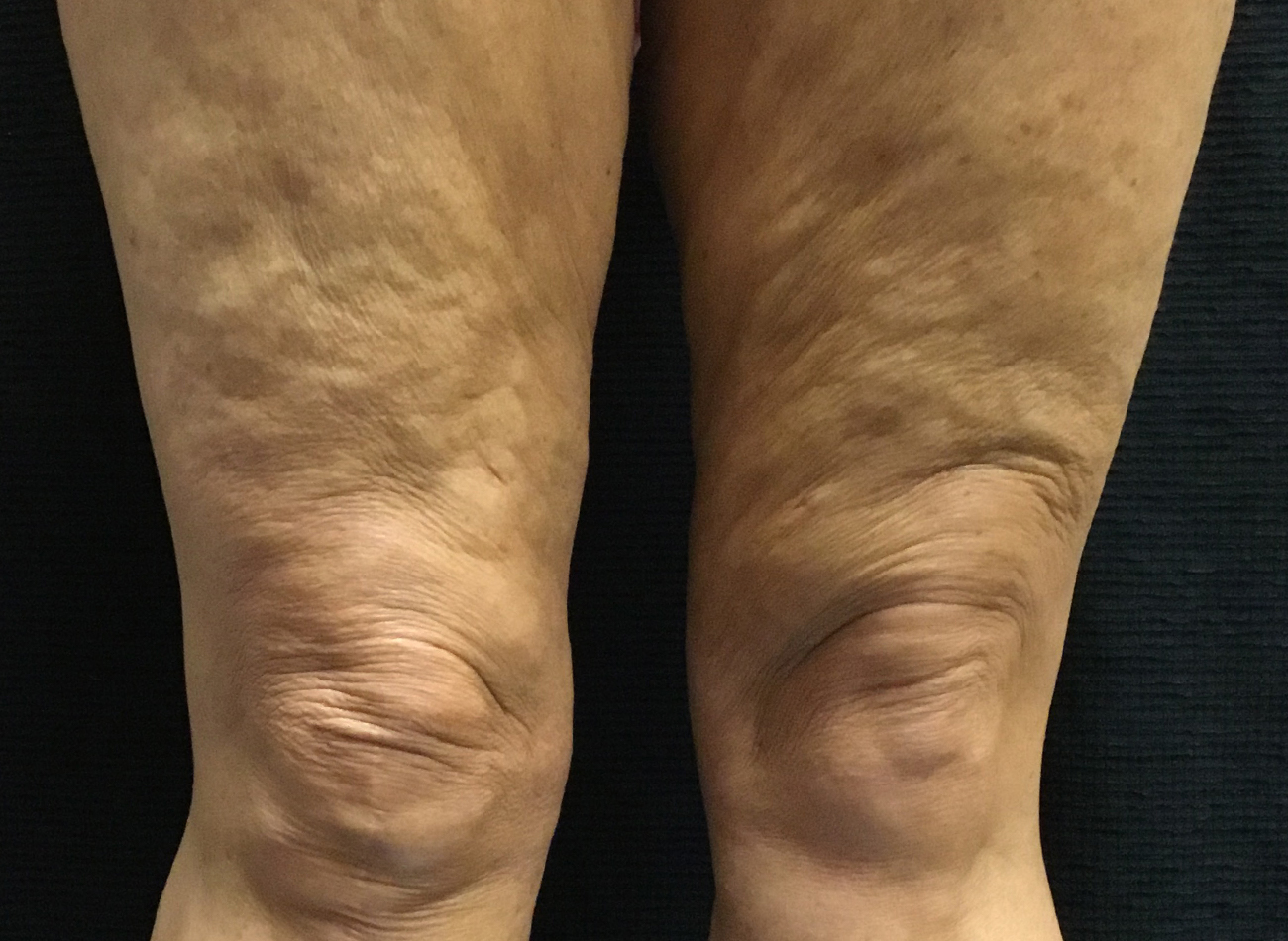 Patient #44674-2: Skin Tightening with Radiofrequency Before Image