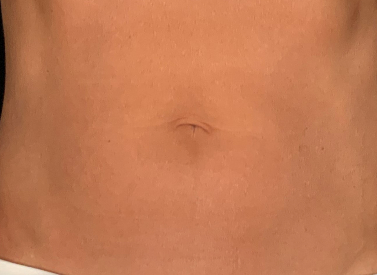Patient #53891: Skin Tightening with Radiofrequency After Image