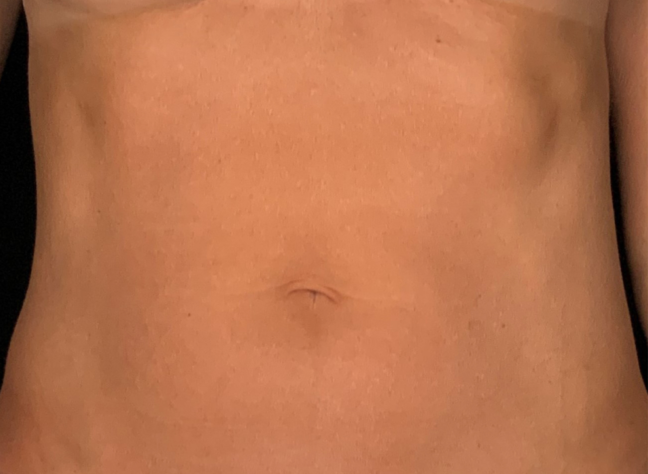 Patient #53891: Skin Tightening with Radiofrequency After Image