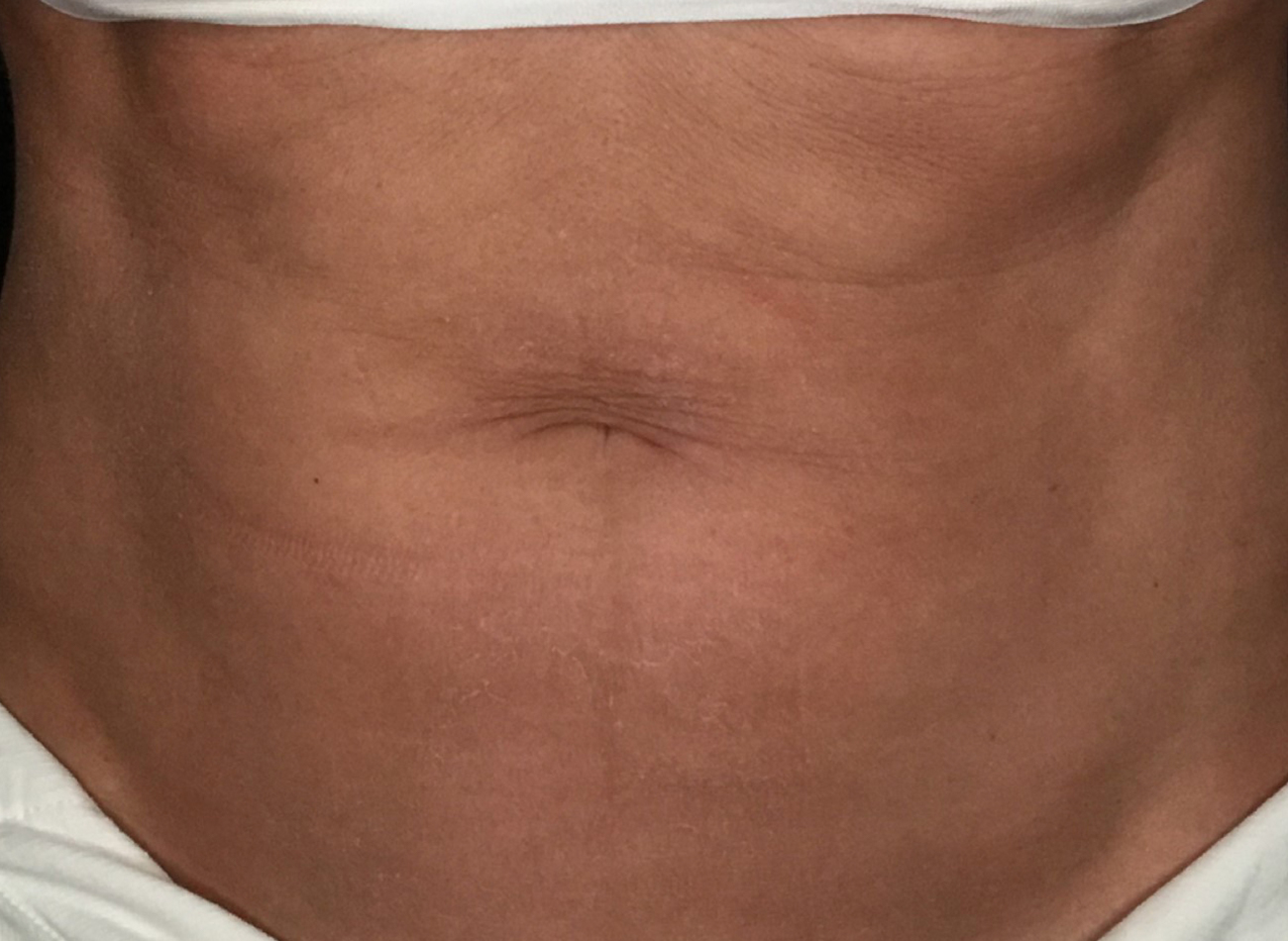 Patient #53891: Skin Tightening with Radiofrequency Before Image
