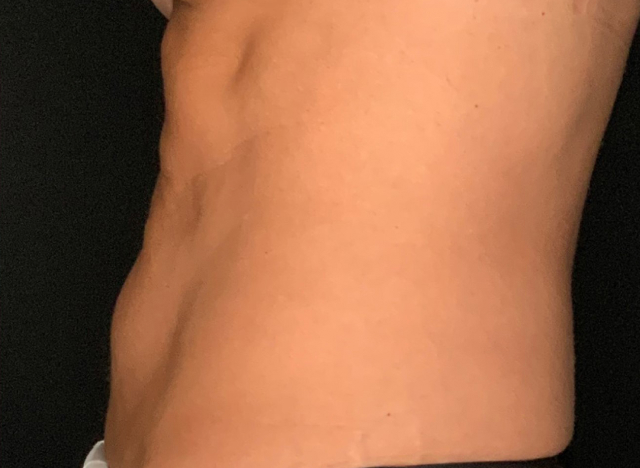 Patient #53891: Skin Tightening with Radiofrequency After Image