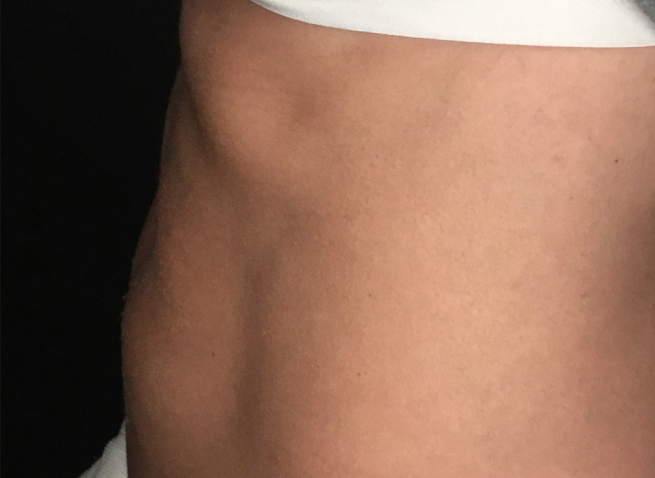 Patient #53891: Skin Tightening with Radiofrequency Before Image