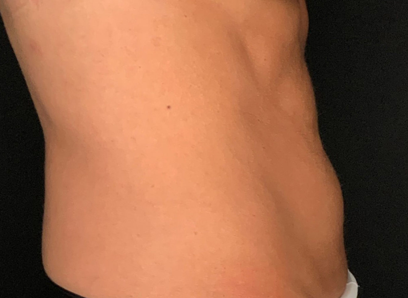 Patient #53891: Skin Tightening with Radiofrequency After Image