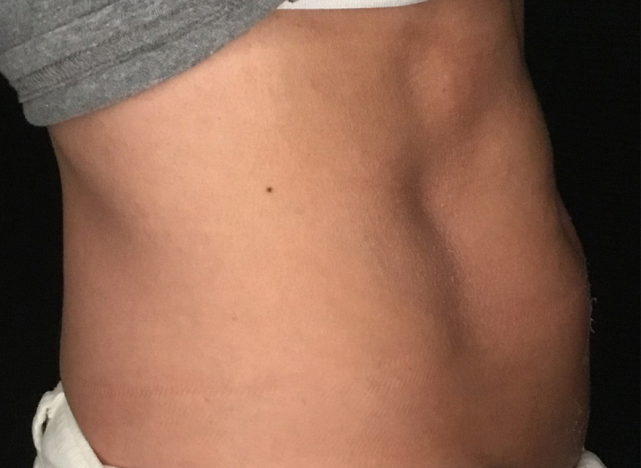 Patient #53891: Skin Tightening with Radiofrequency Before Image