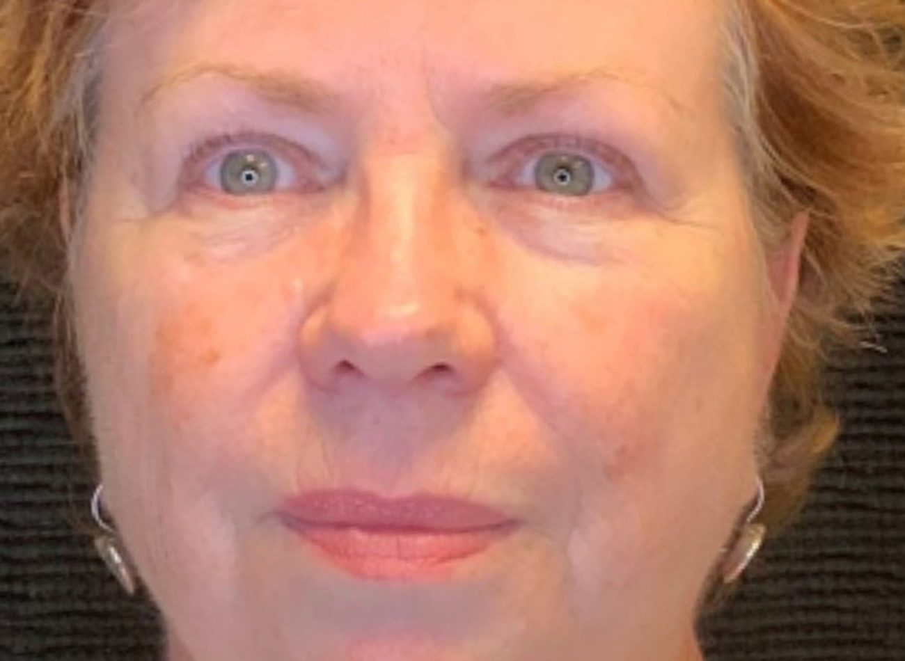 Patient #49987: 3 For Me Refresh After Image