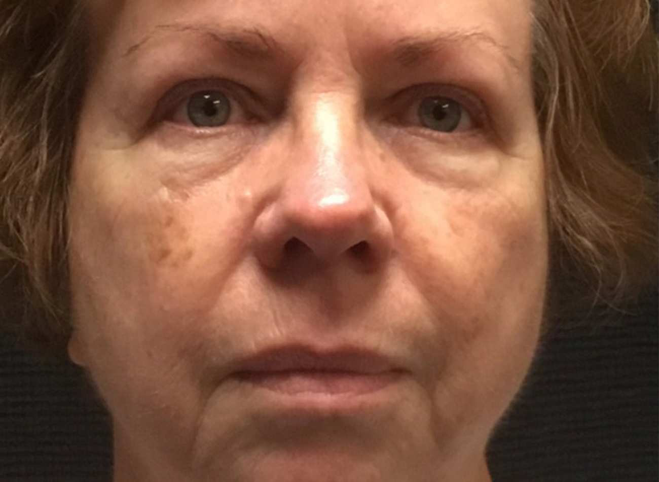 Patient #49987: 3 For Me Refresh Before Image