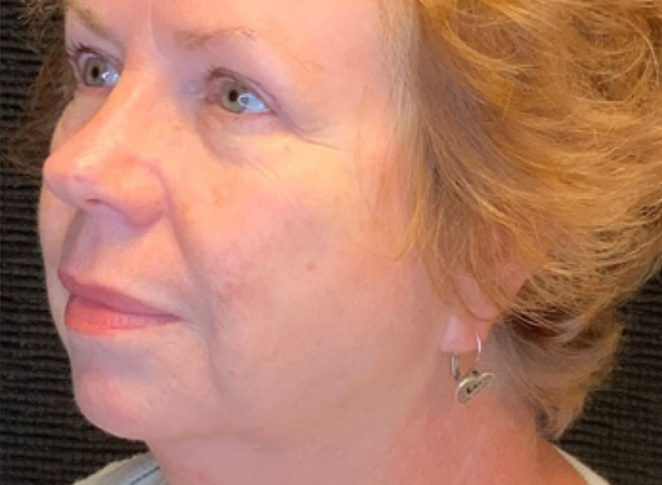 Patient #49987: 3 For Me Refresh After Image