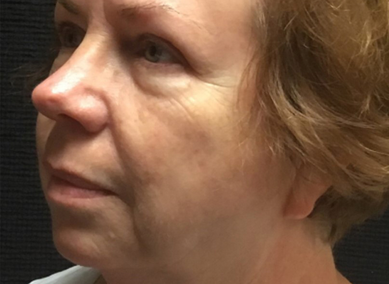 Patient #49987: 3 For Me Refresh Before Image