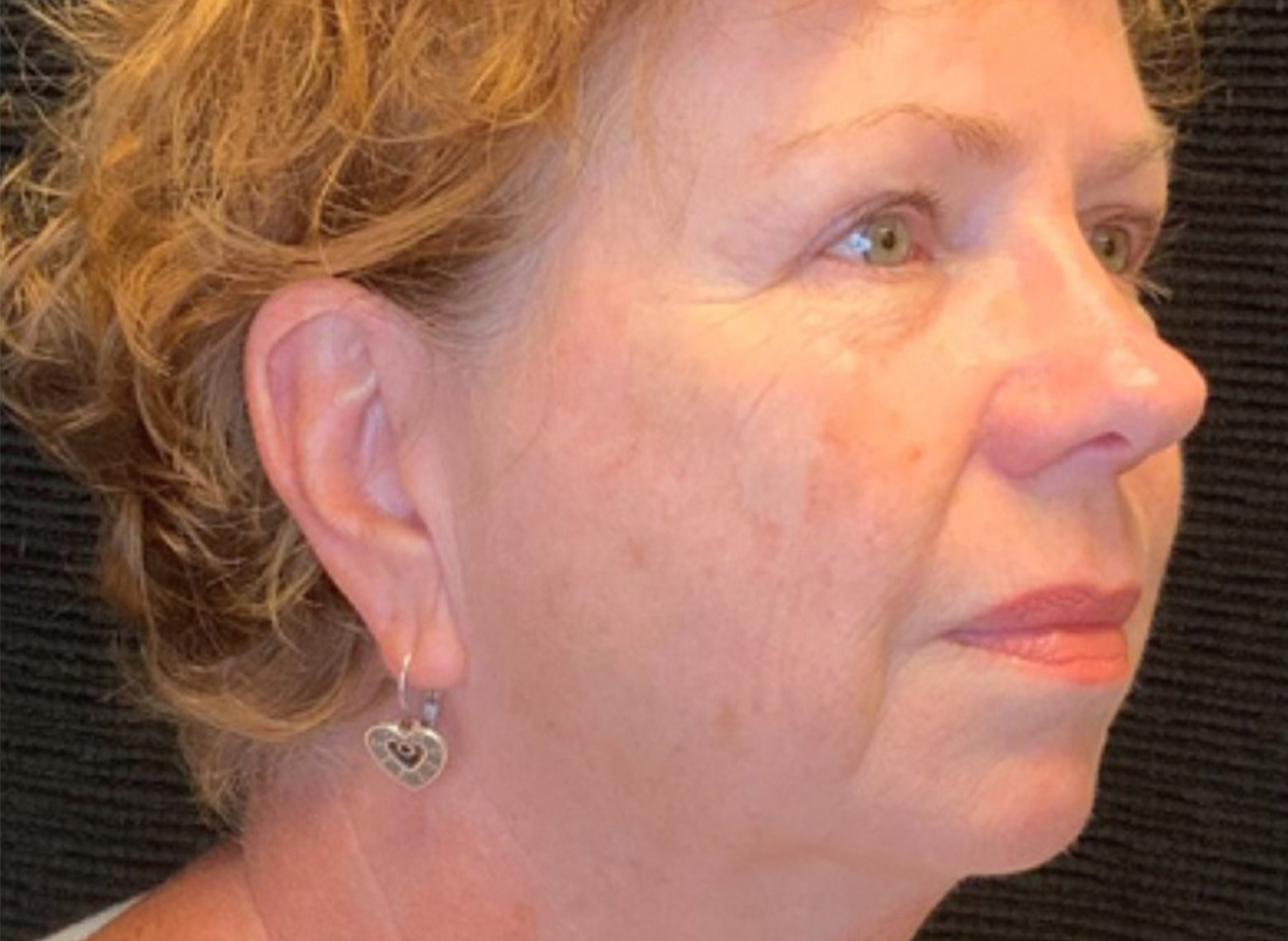 Patient #49987: 3 For Me Refresh After Image