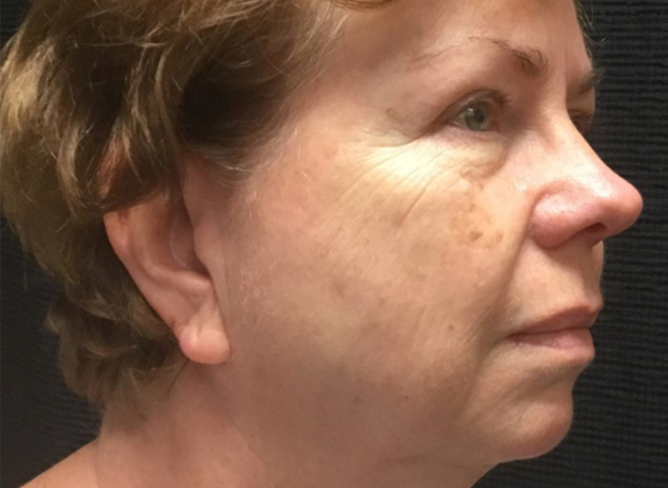 Patient #49987: 3 For Me Refresh Before Image