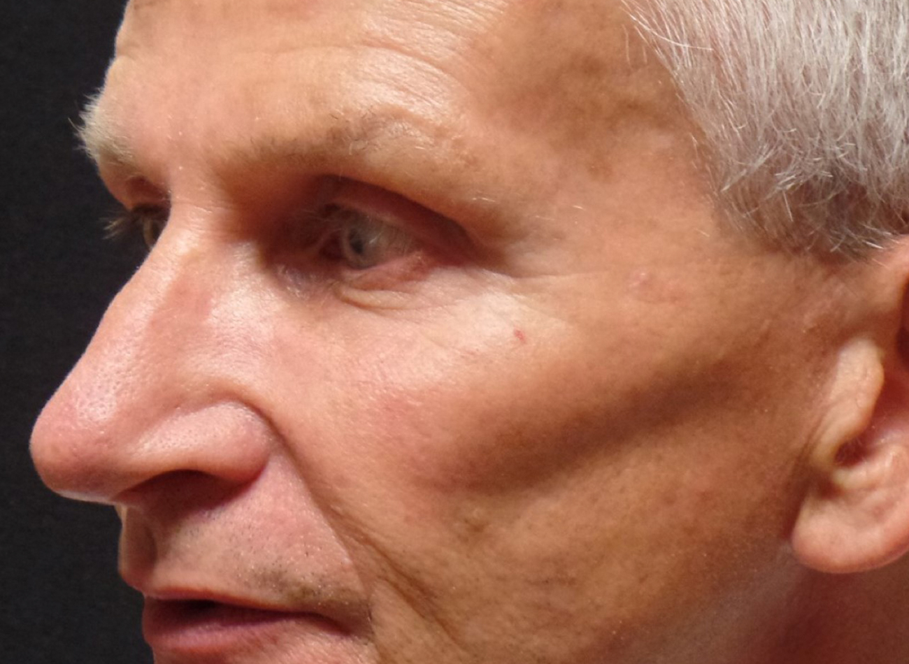 Patient #74935-2: 3 For Me Refresh After Image