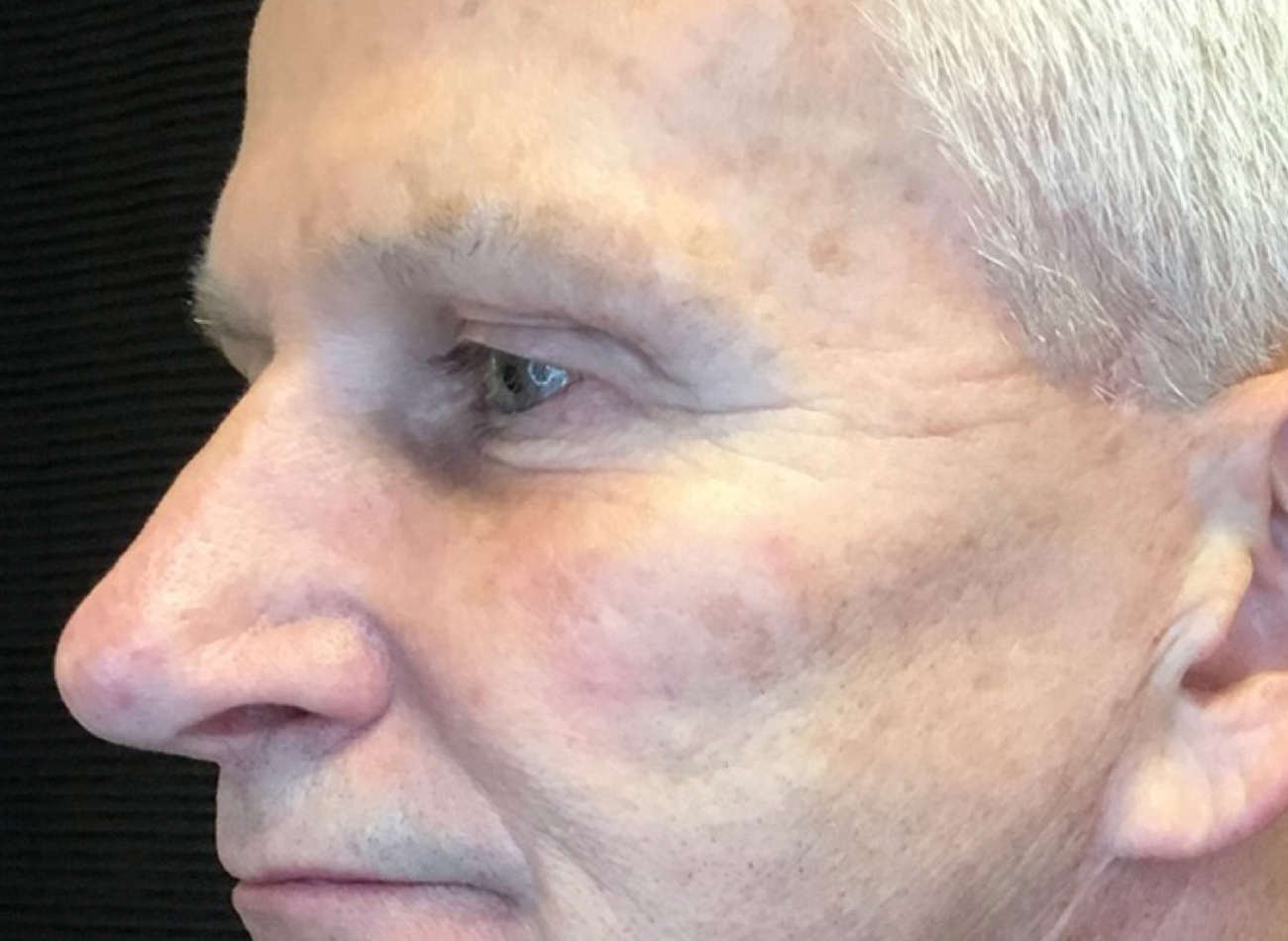 Patient #74935-2: 3 For Me Refresh Before Image