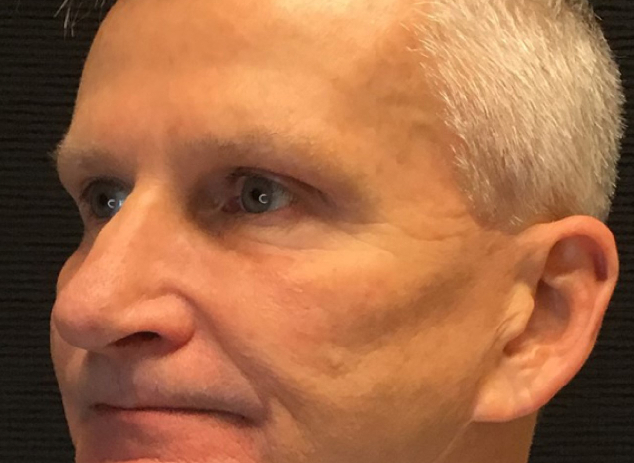 Patient #74935-2: 3 For Me Refresh After Image