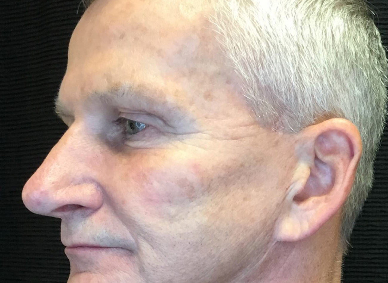 Patient #74935-2: 3 For Me Refresh Before Image