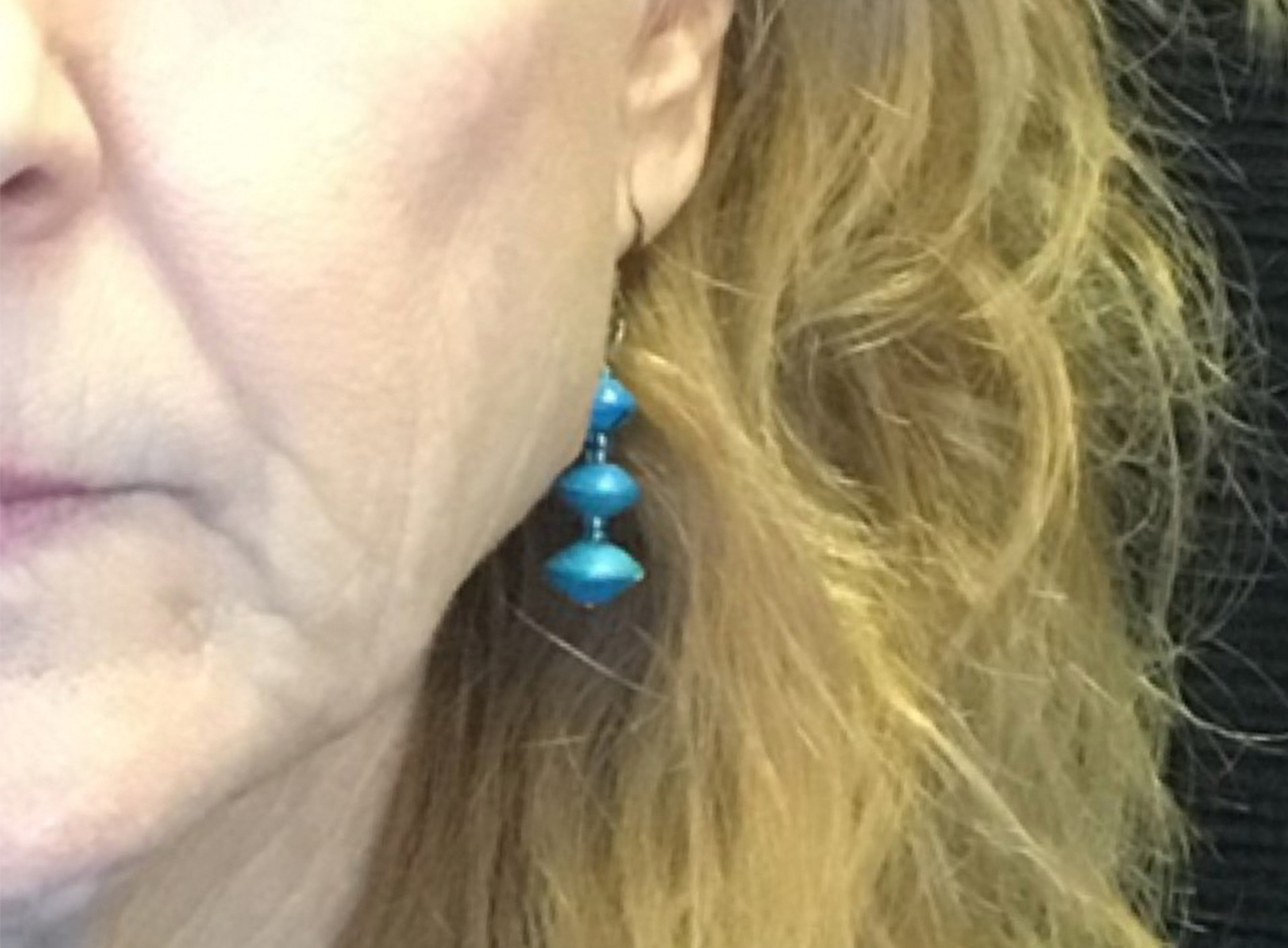 Patient #89085: 3 For Me Refresh After Image