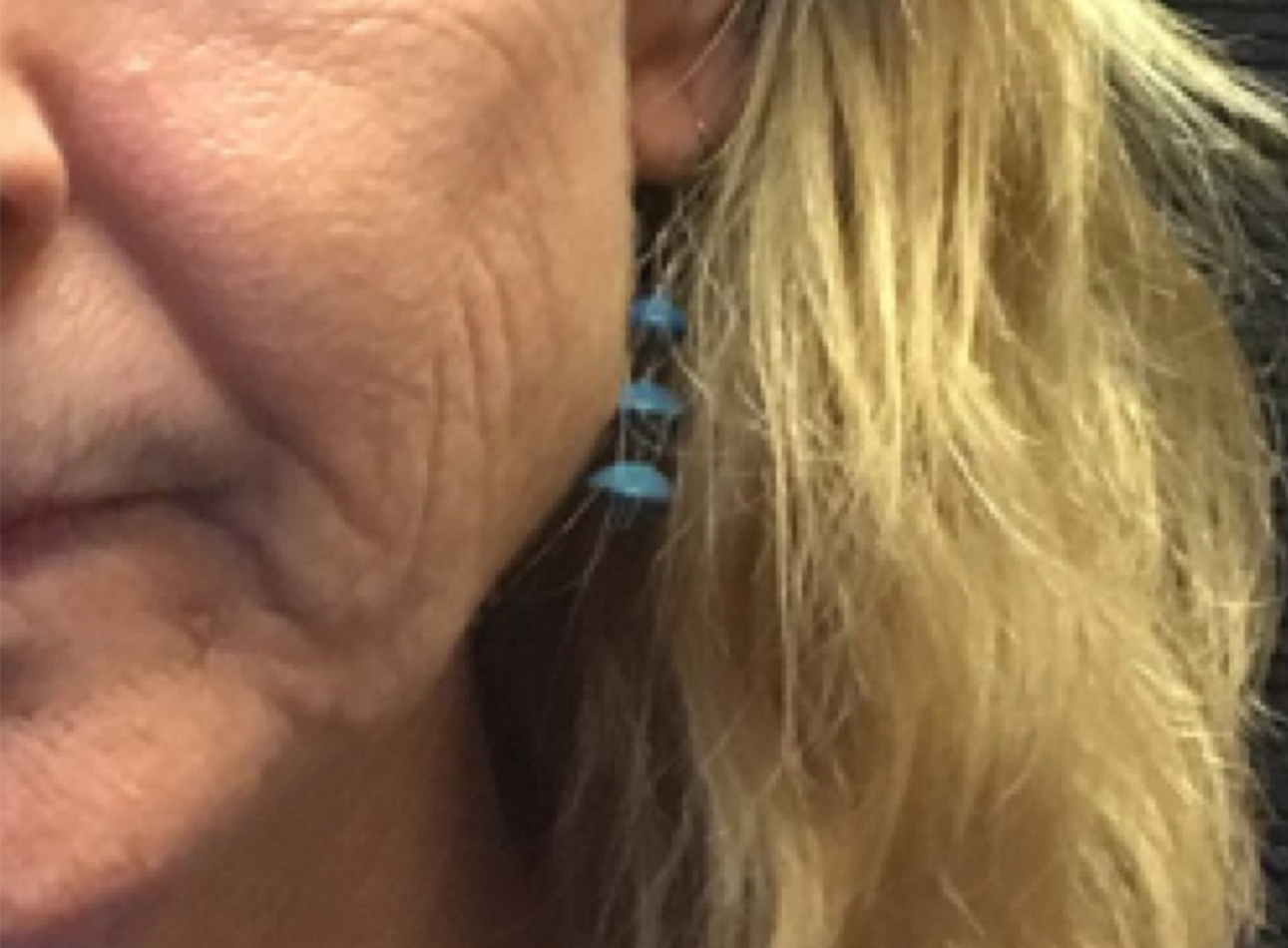 Patient #89085: 3 For Me Refresh Before Image