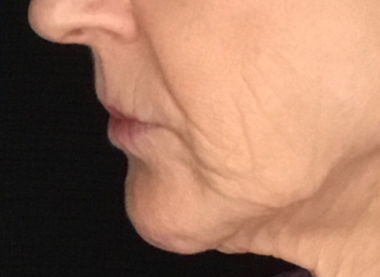 Patient #89085: 3 For Me Refresh After Image