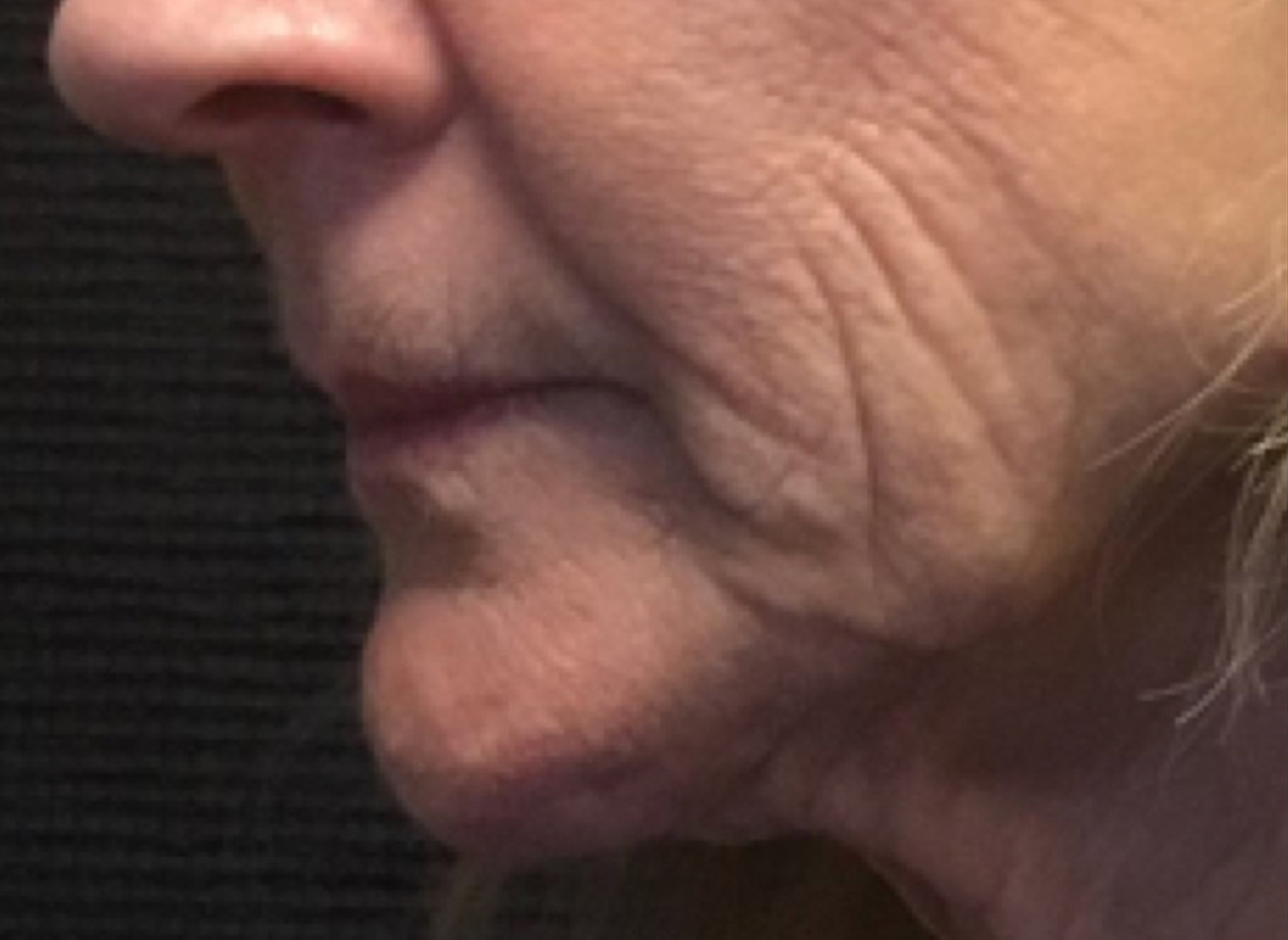 Patient #89085: 3 For Me Refresh Before Image