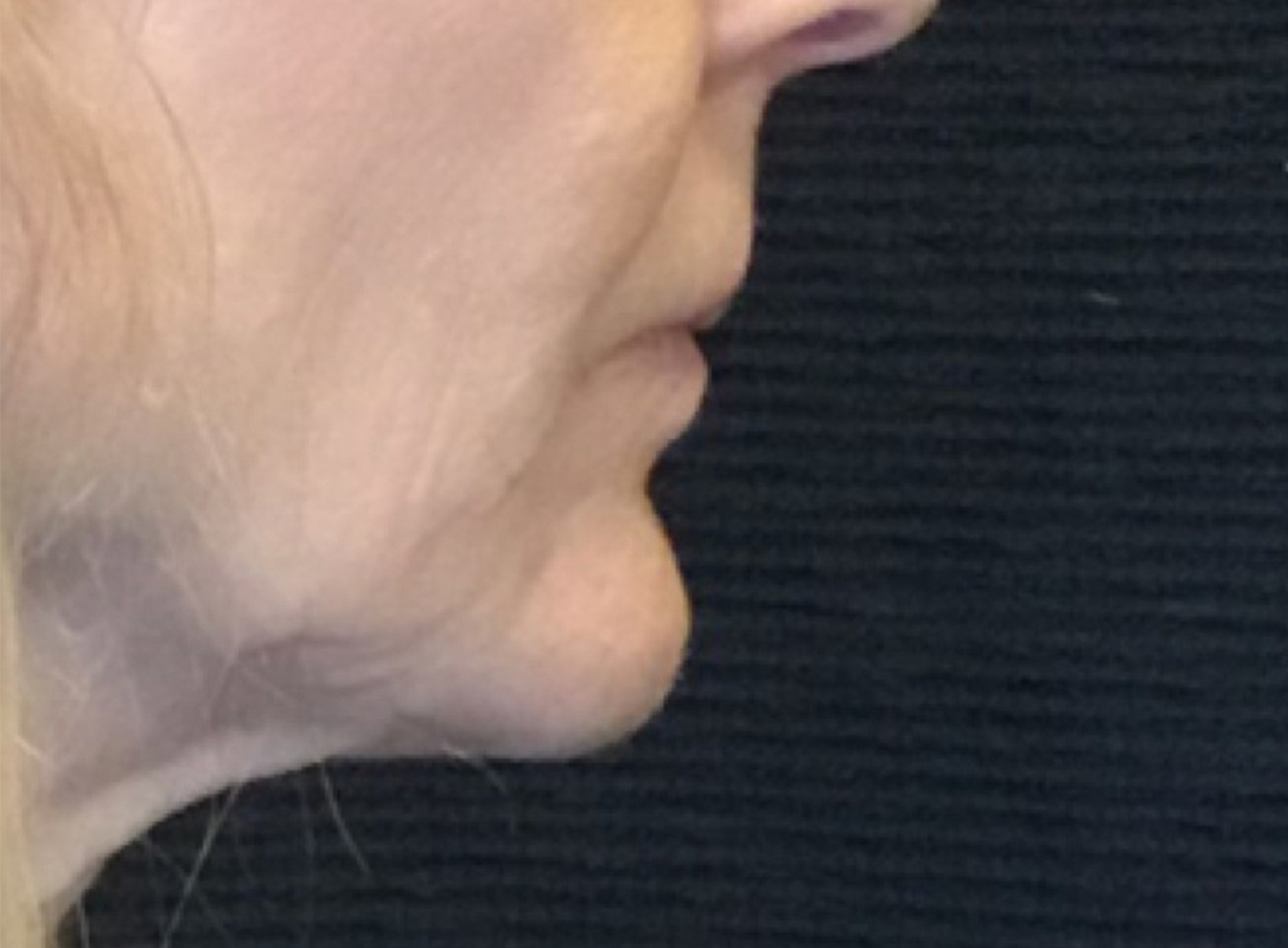 Patient #89085: 3 For Me Refresh After Image