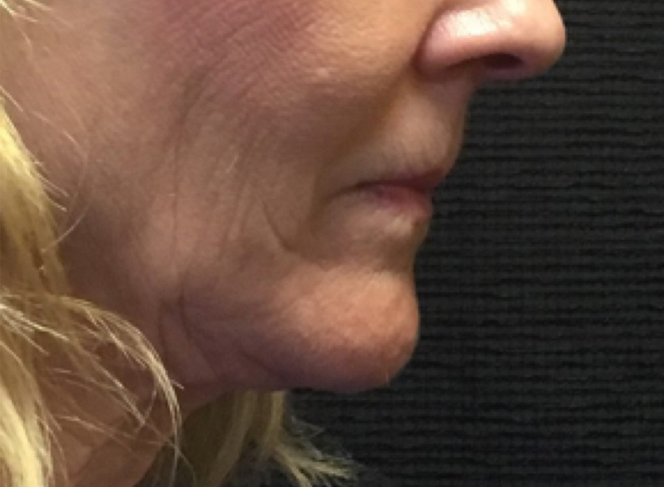 Patient #89085: 3 For Me Refresh Before Image