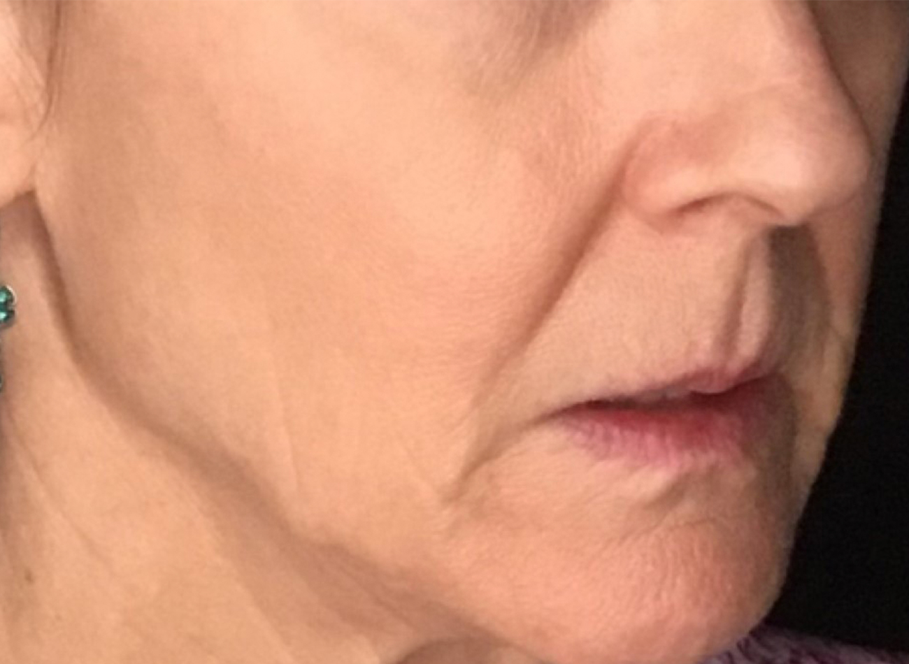 Patient #89085: 3 For Me Refresh After Image