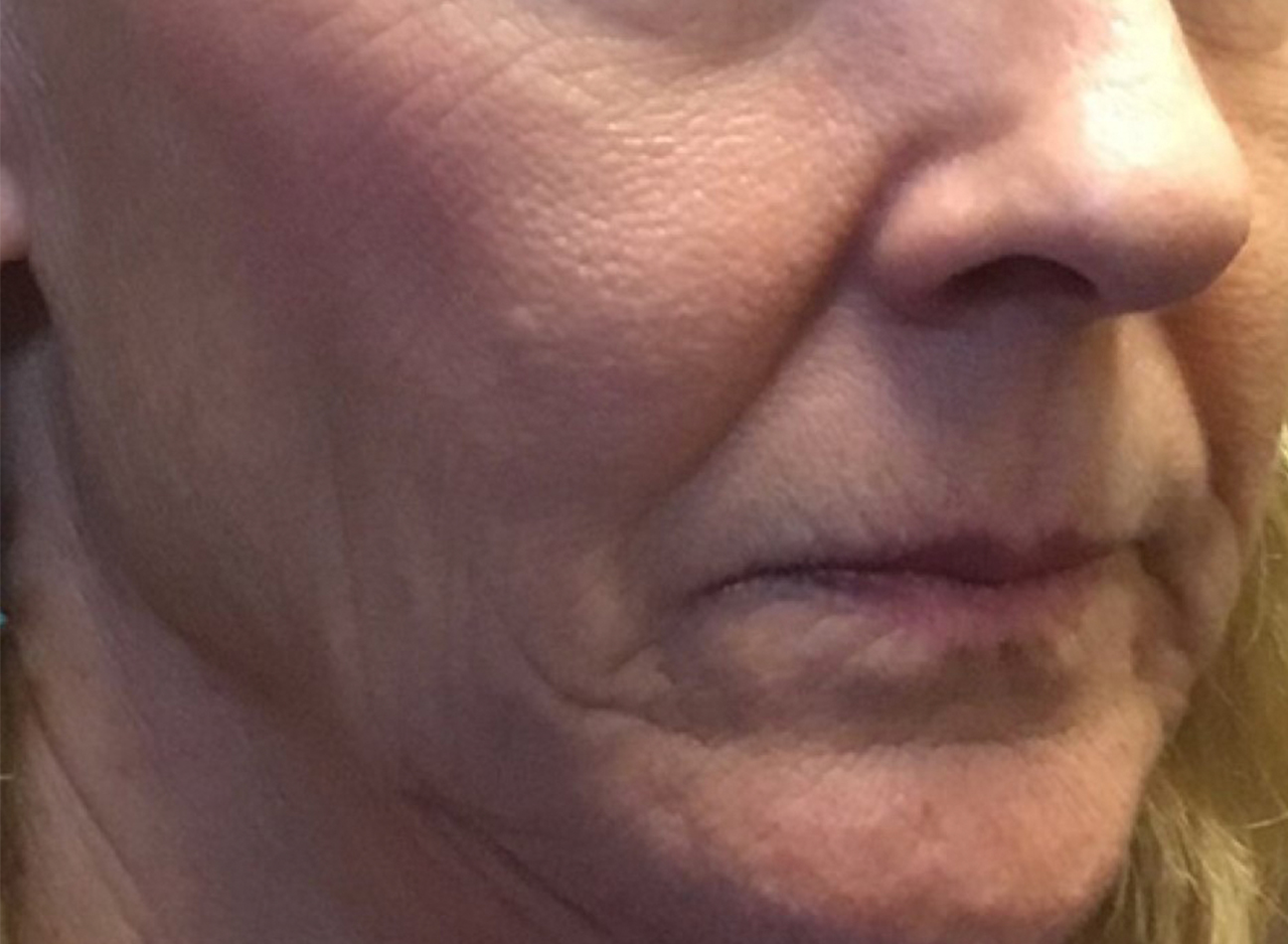 Patient #89085: 3 For Me Refresh Before Image