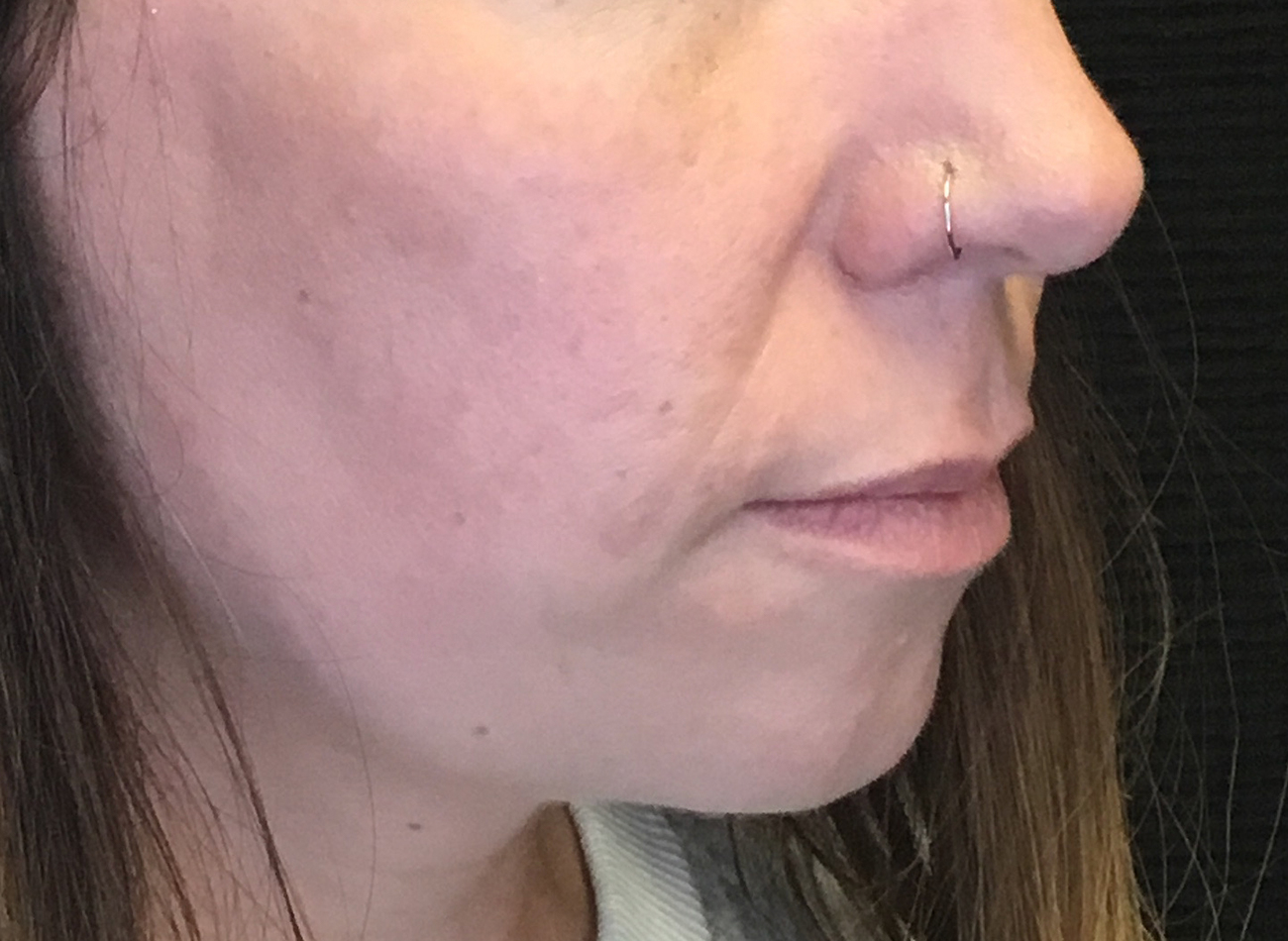 Patient #81499: Bellafill for Acne Scarring After Image