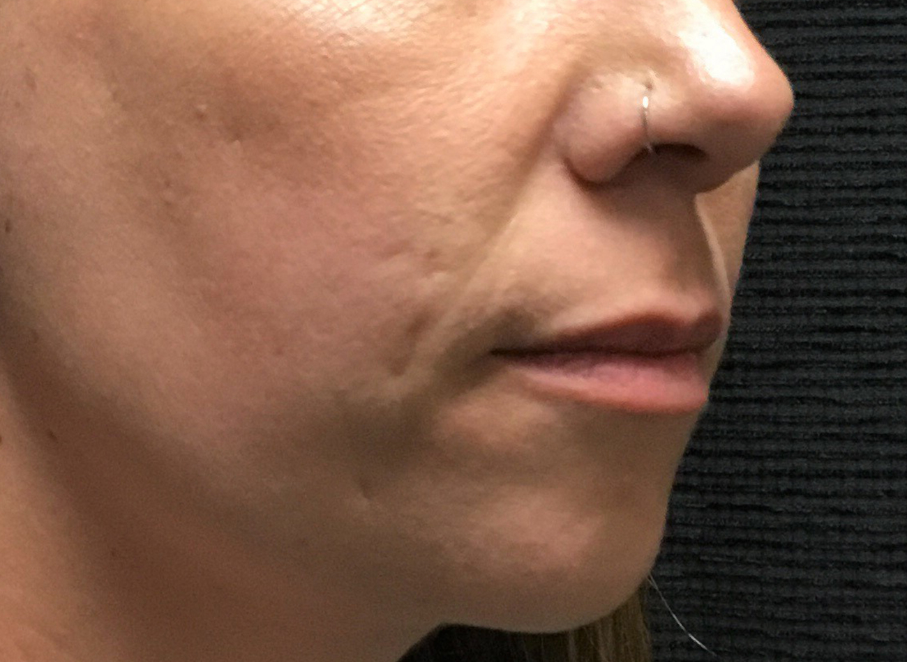 Patient #81499: Bellafill for Acne Scarring Before Image