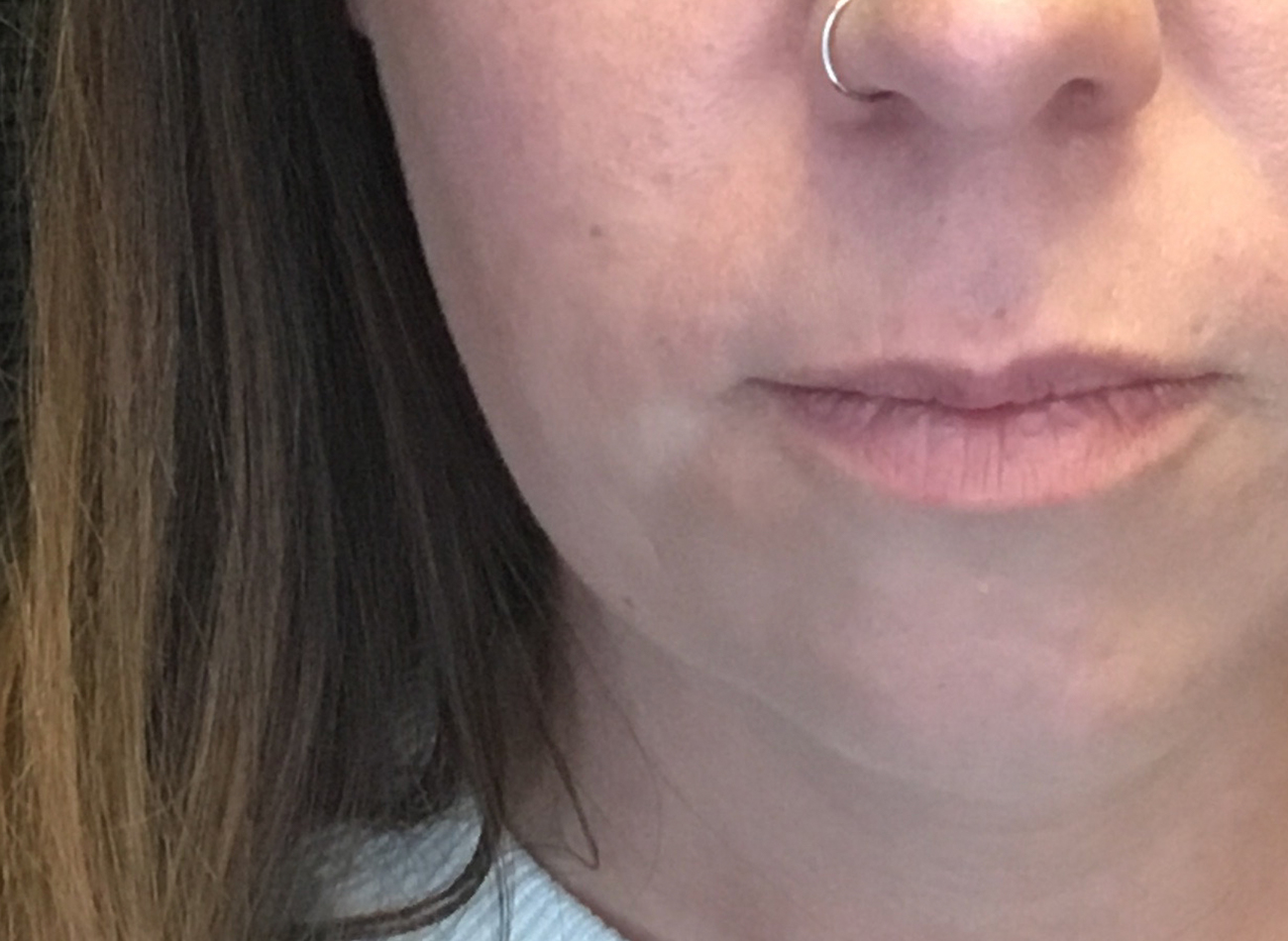 Patient #81499: Bellafill for Acne Scarring After Image