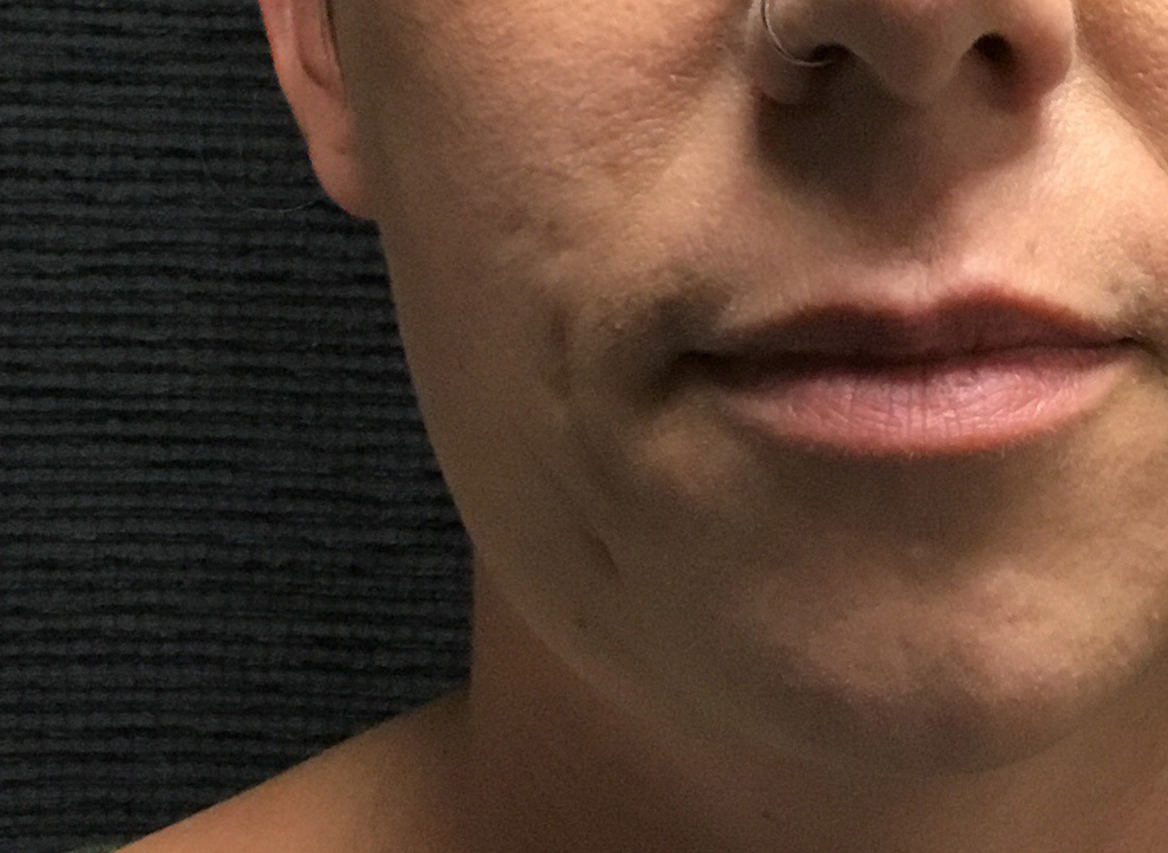 Patient #81499: Bellafill for Acne Scarring Before Image