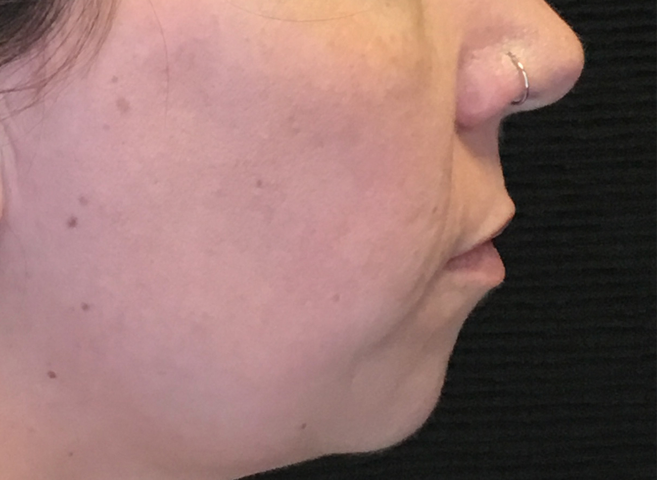 Patient #81499: Bellafill for Acne Scarring After Image