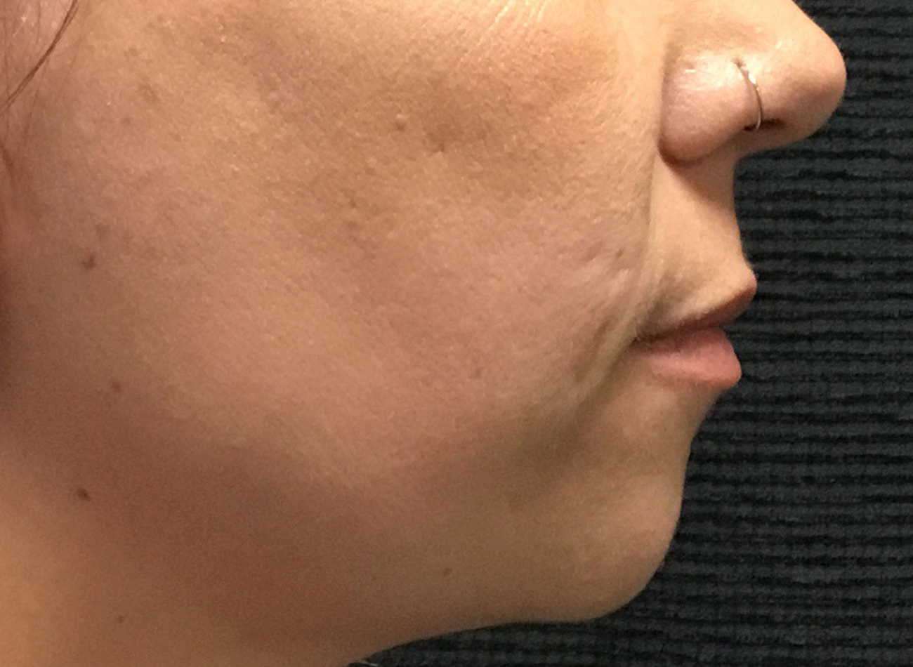 Patient #81499: Bellafill for Acne Scarring Before Image