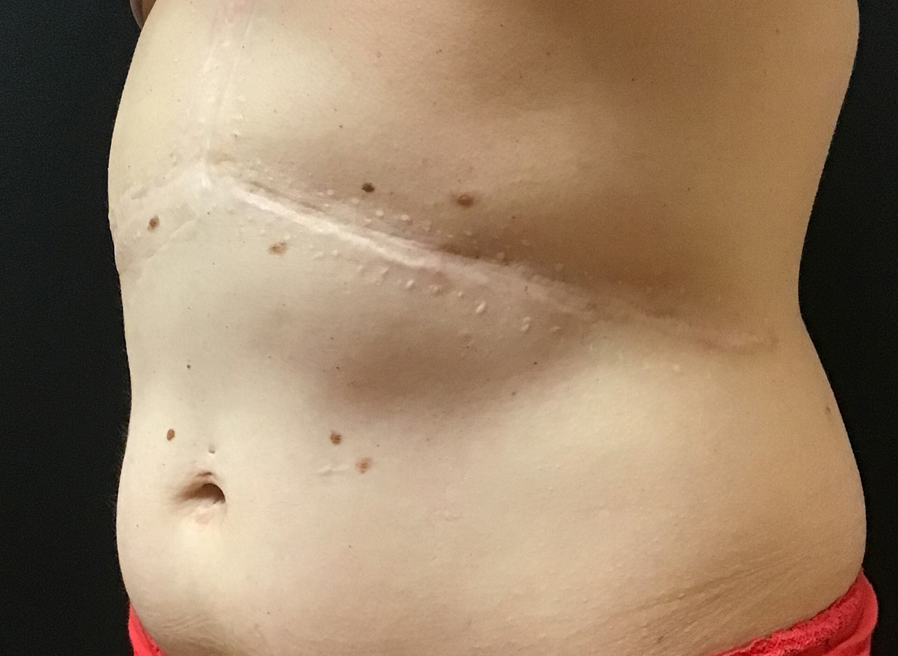 Patient #63014: CoolSculpting After Image