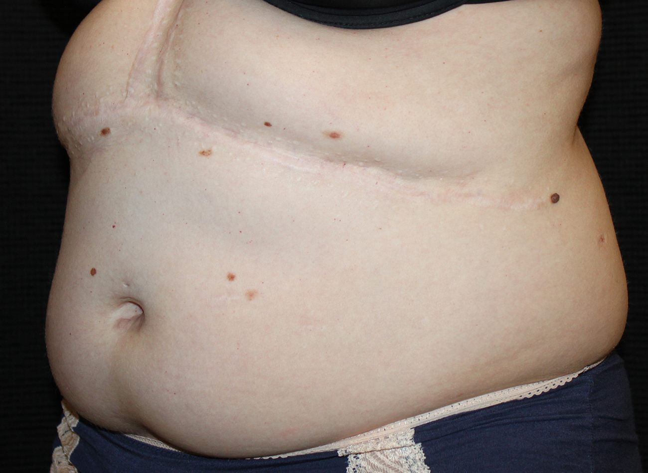 Patient #63014: CoolSculpting Before Image