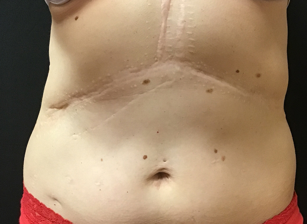 Patient #63014: CoolSculpting After Image