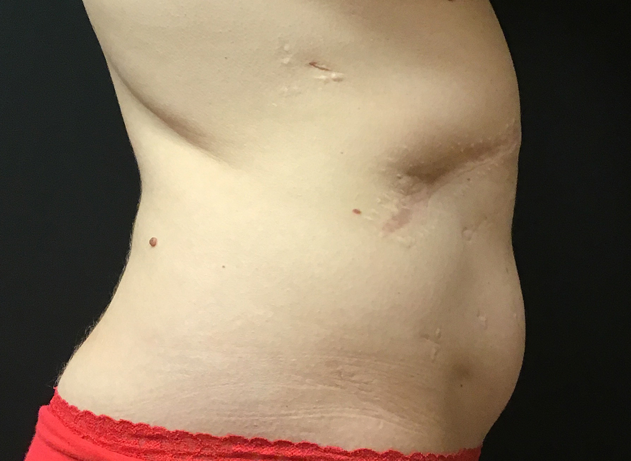 Patient #63014: CoolSculpting After Image