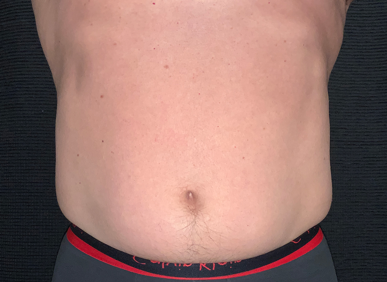 Patient #65839-2: CoolSculpting After Image