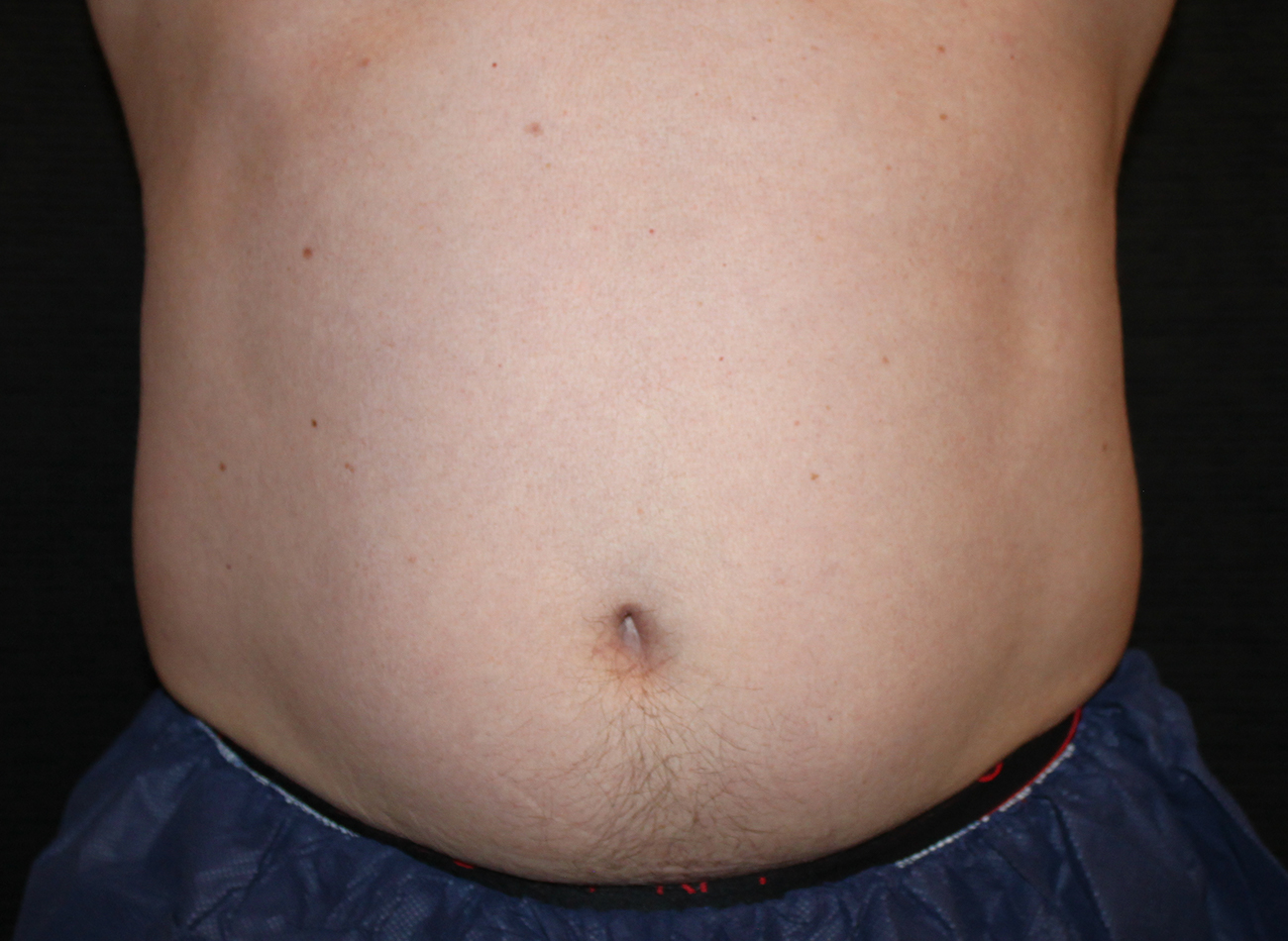 Patient #65839-2: CoolSculpting Before Image